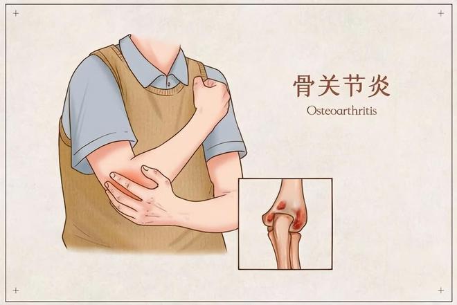 期出现这些症状可能是关节炎在作怪！千亿球友会且行且珍“膝”!老年人长(图2)